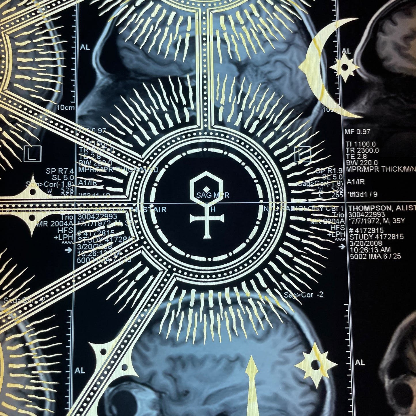 Sephiroth Laser Etched MRI Print 4